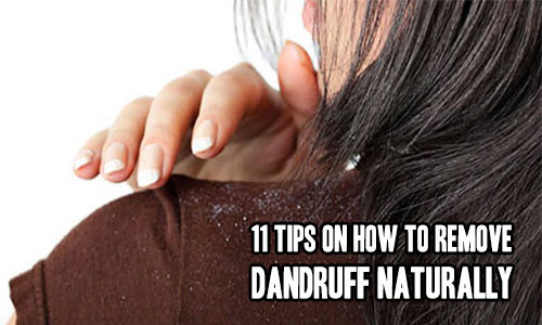 11 Tips On How To Remove Dandruff Naturally