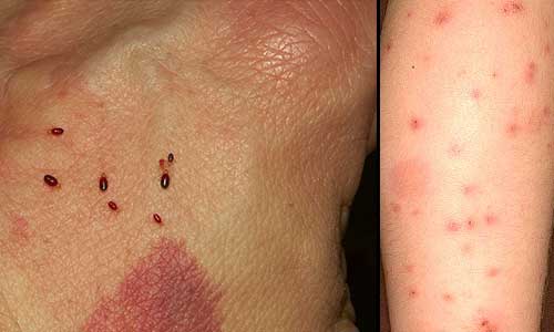bugs bites bedbugs identifying bite iseeidoimake paw tattoo