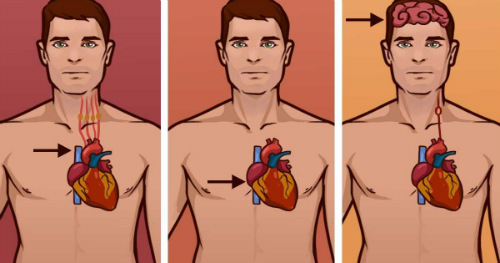 Know the Difference Between a Heart Attack, Cardiac Arrest and a Stroke. It Could Save a Life!